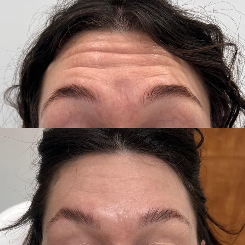 Reduces wrinkles and fine lines for a smoother, younger-looking appearance.
