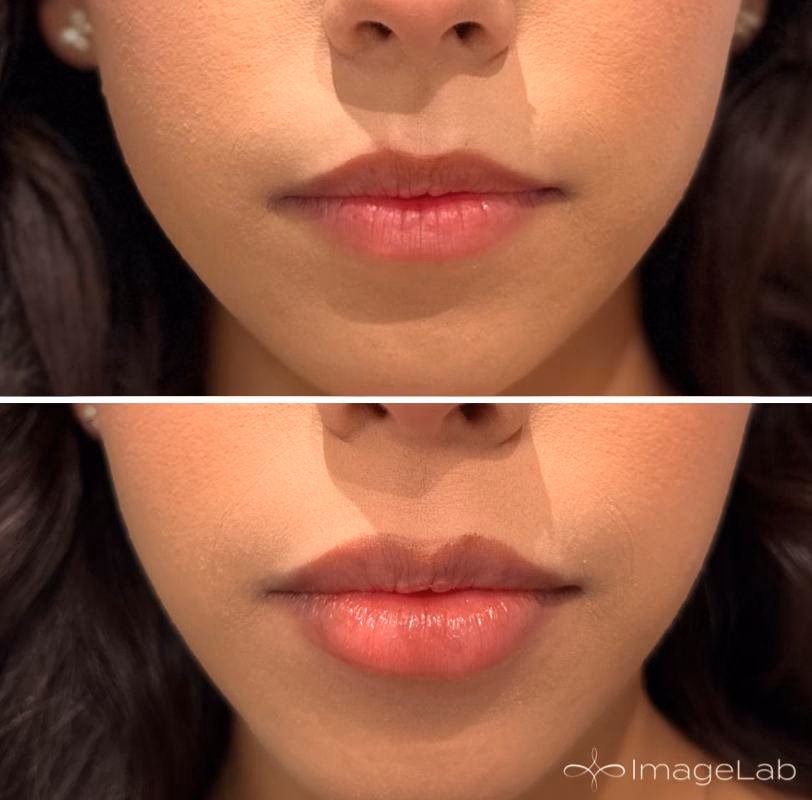 Enhances facial contours and adds natural volume to cheeks, lips, and more.