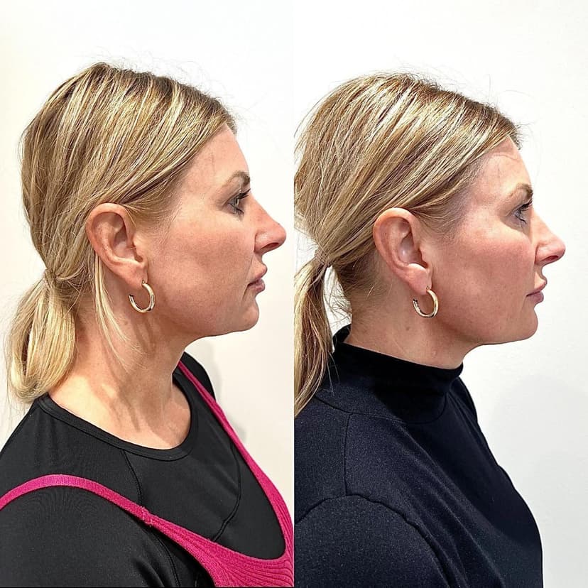 Stimulates collagen production for long-lasting, natural results.