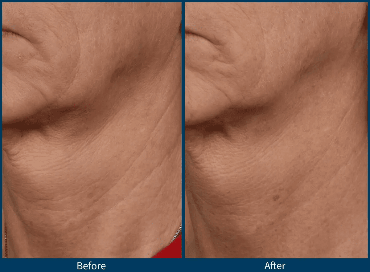 Microneedling before and after for fine lines and wrinkles at ImageLab Med Spa