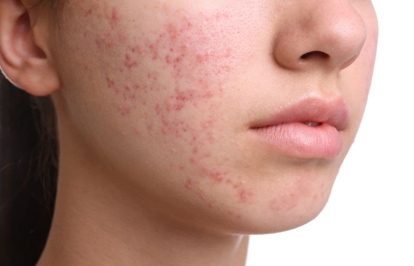 deep chemical peel