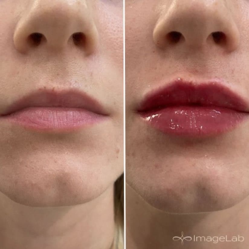Best Lip Fillers in Chicago | Enhance Your Lips at ImageLab Med Spa