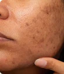 Pigmentation / Hyperpigmentation