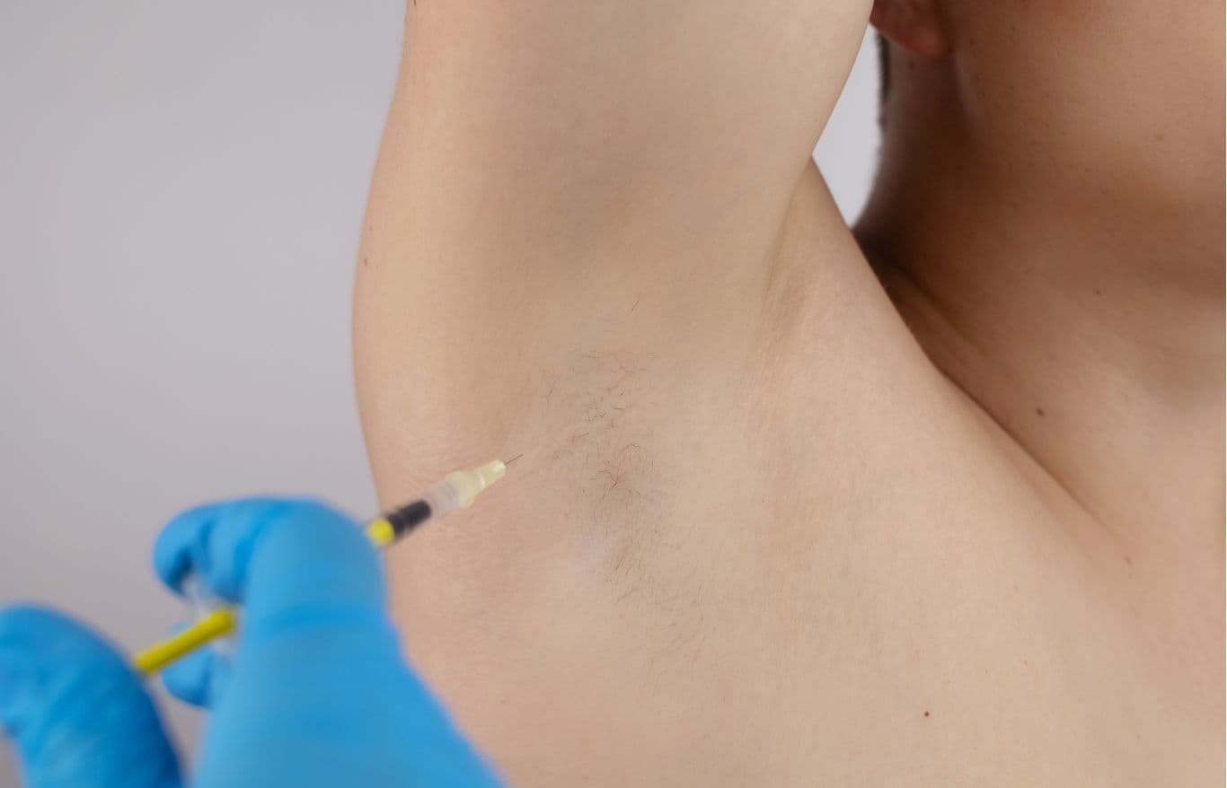 botox injection for sweat reduction