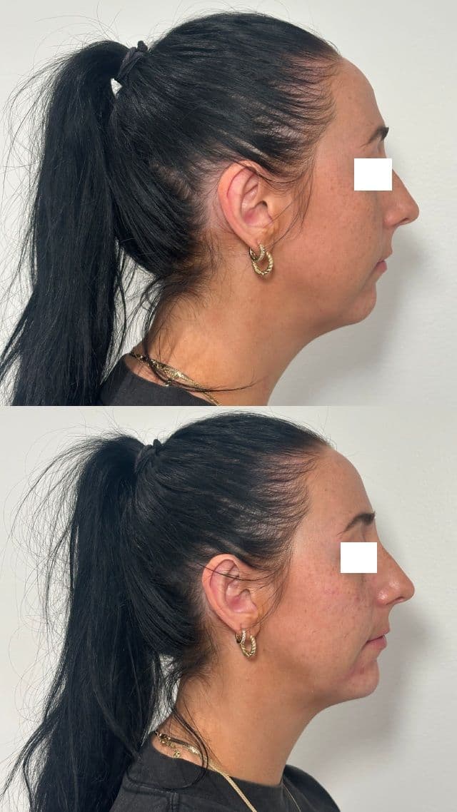 Dermal Filler result at ImageLab Med Spa