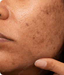 Pigmentation