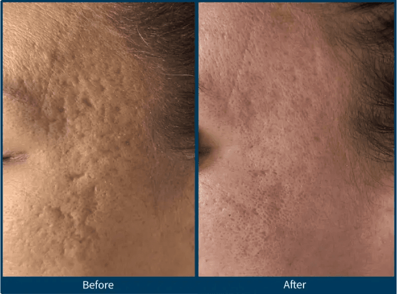 Microneedling before and after for skin texture improvement at ImageLab Med Spa