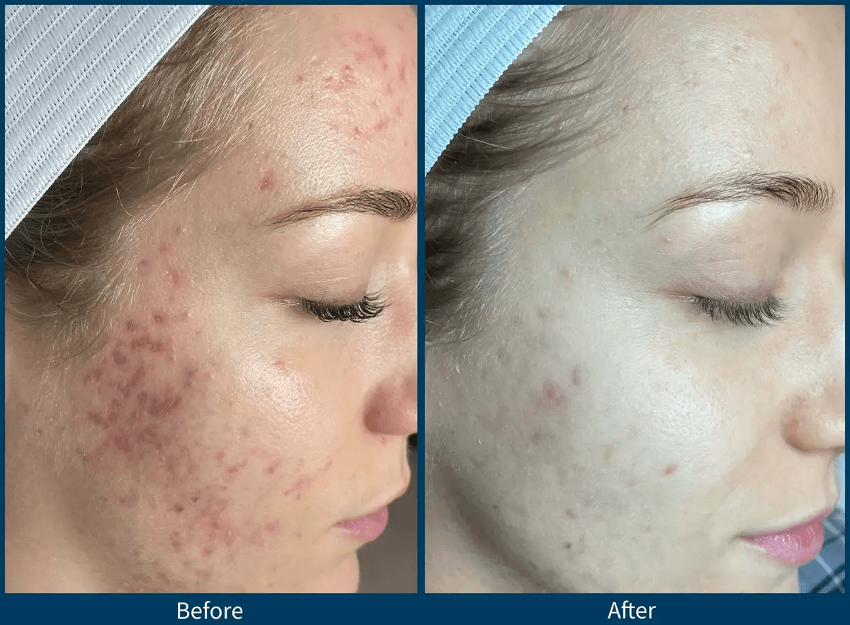 Microneedling before and after results for acne scars at ImageLab Med Spa Chicago