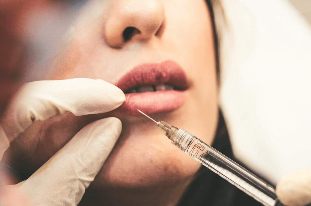 Lip Fillers