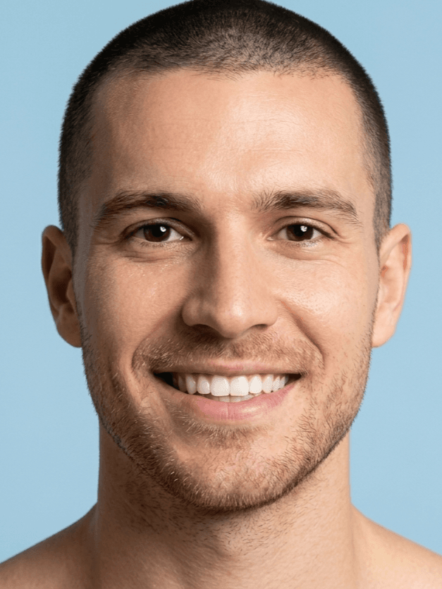 Male face diagram showing Botox treatment areas