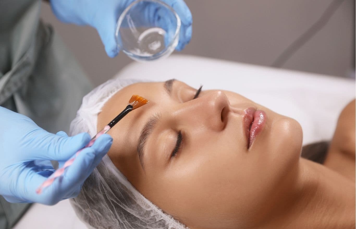 chemical peels rockford il