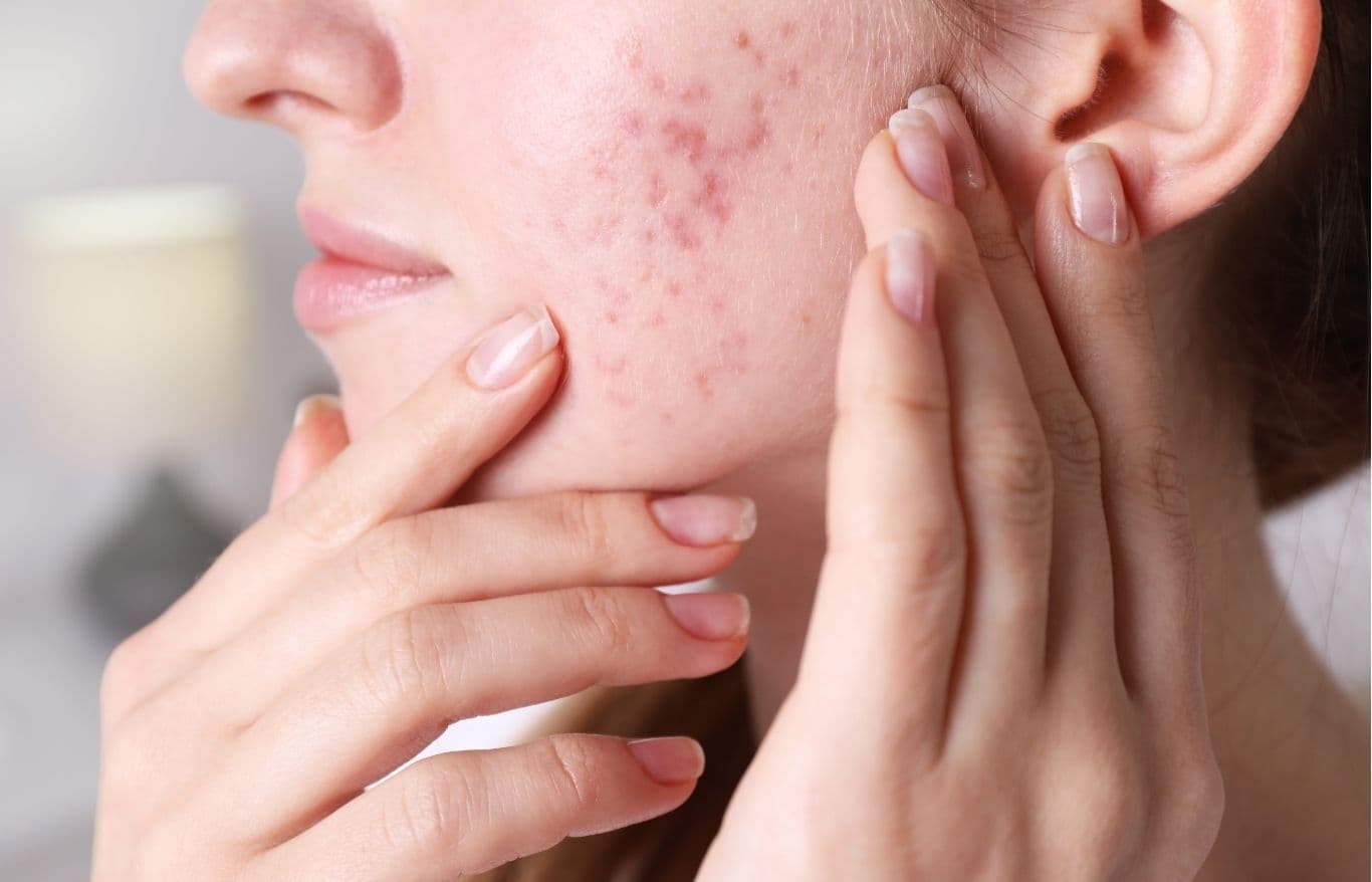 Erase Acne Scarring