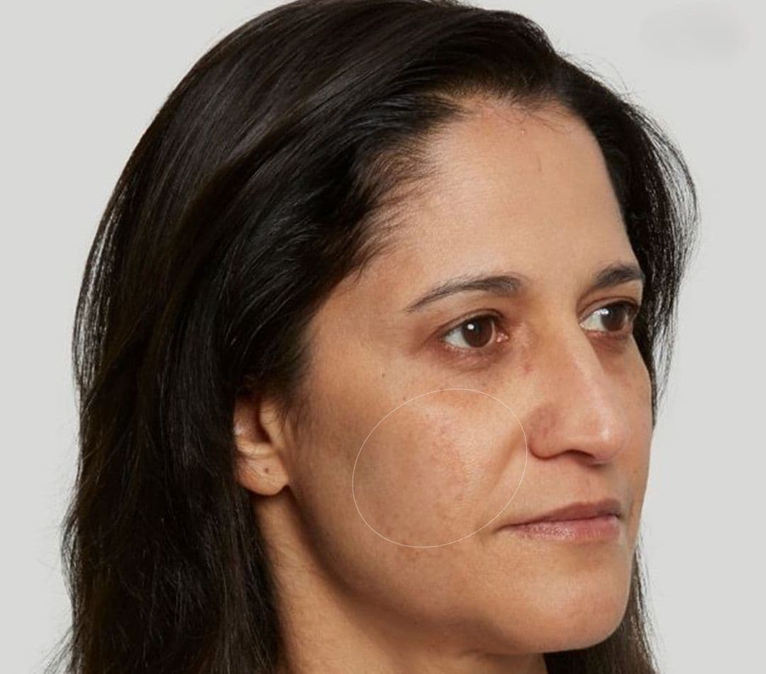 Volume Loss / Hollowing / Deflation