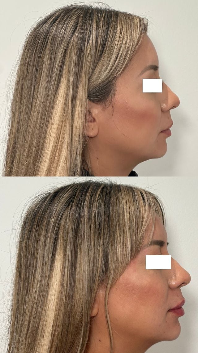 Before and after result