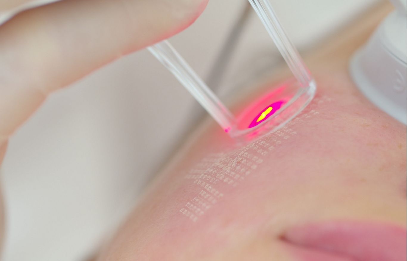 fractional laser resurfacing for texture