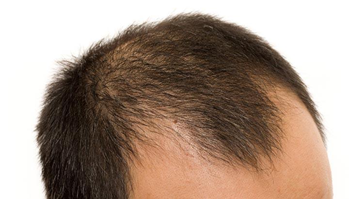 Pattern Baldness