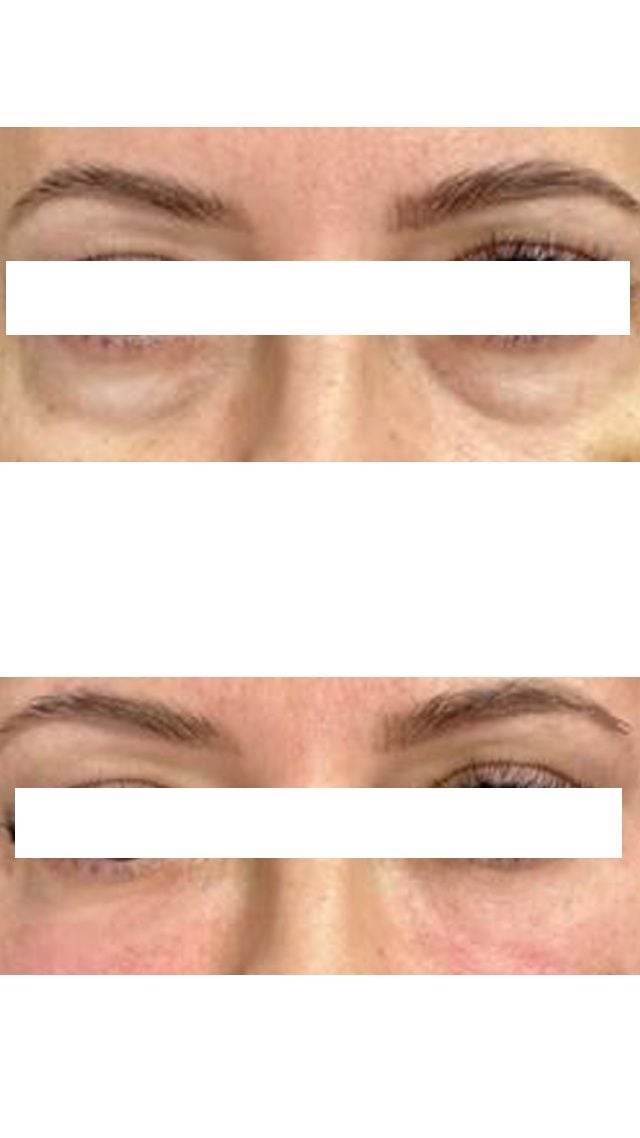 Before and after result