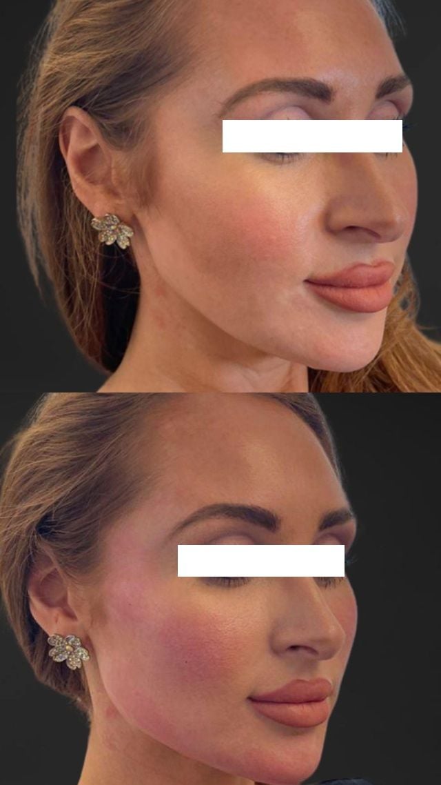 Before and after result