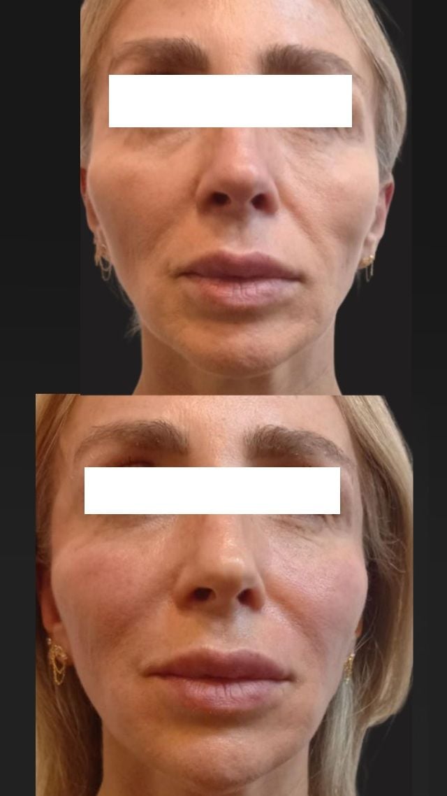 Before and after result