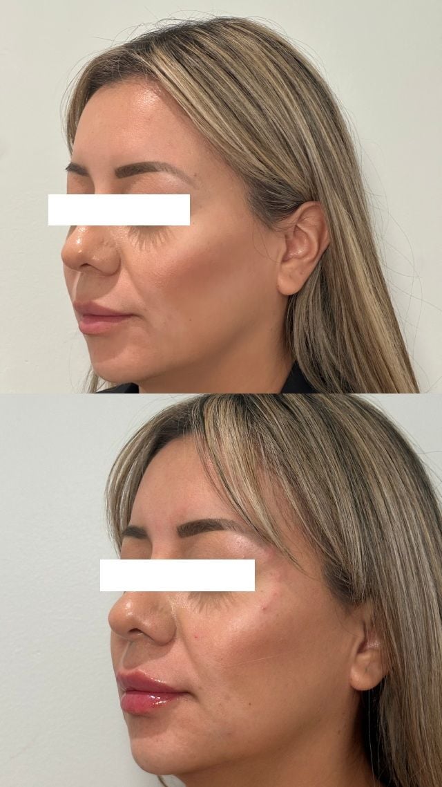 Before and after result