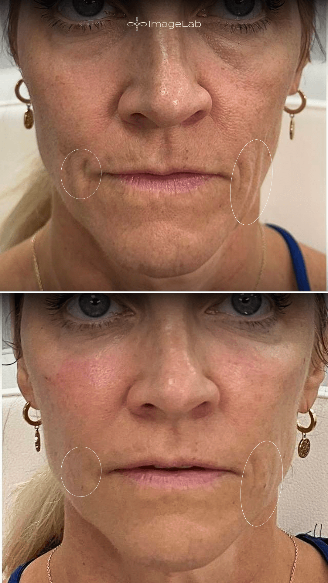 Before and after result