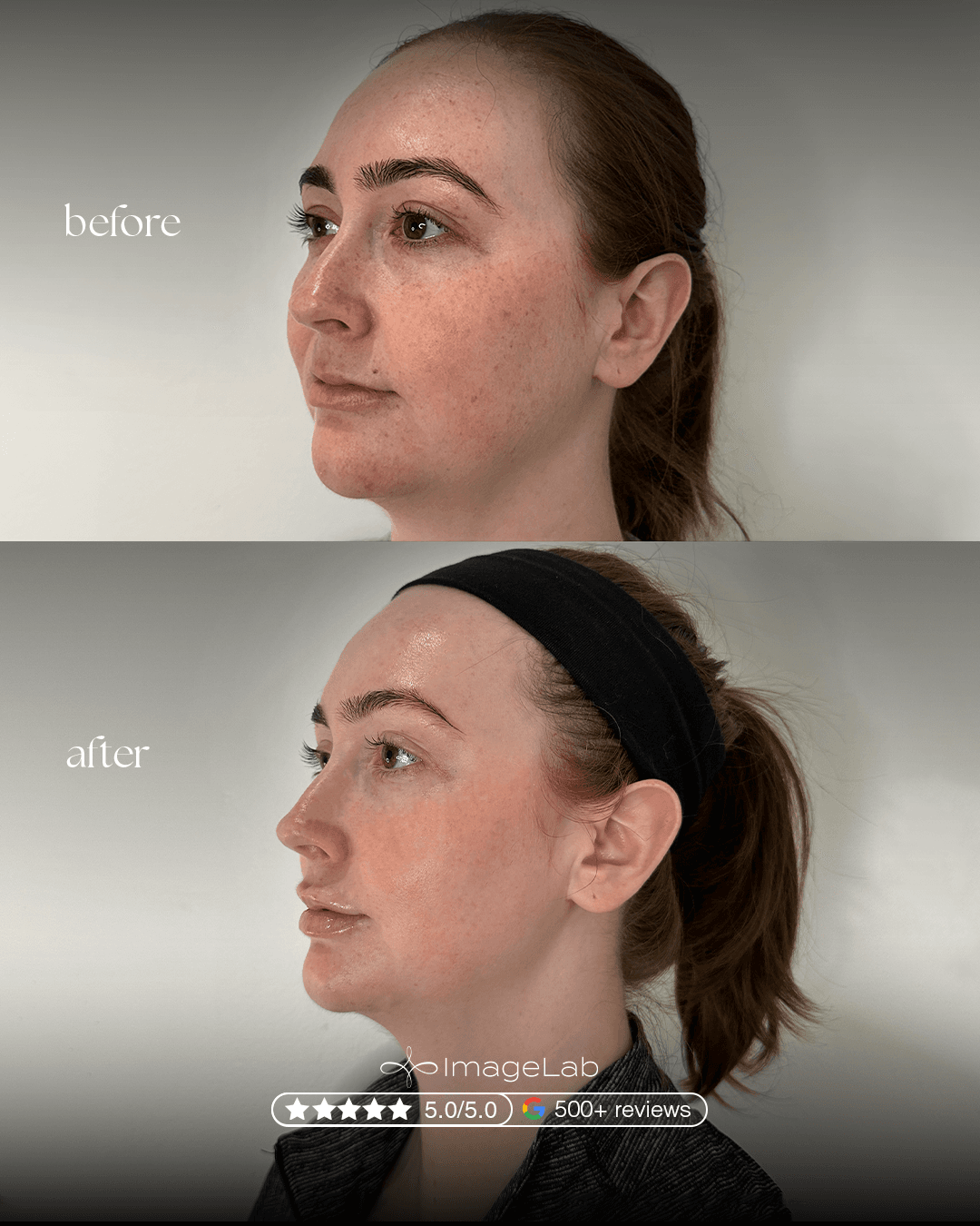 Facial Balancing result at ImageLab Med Spa