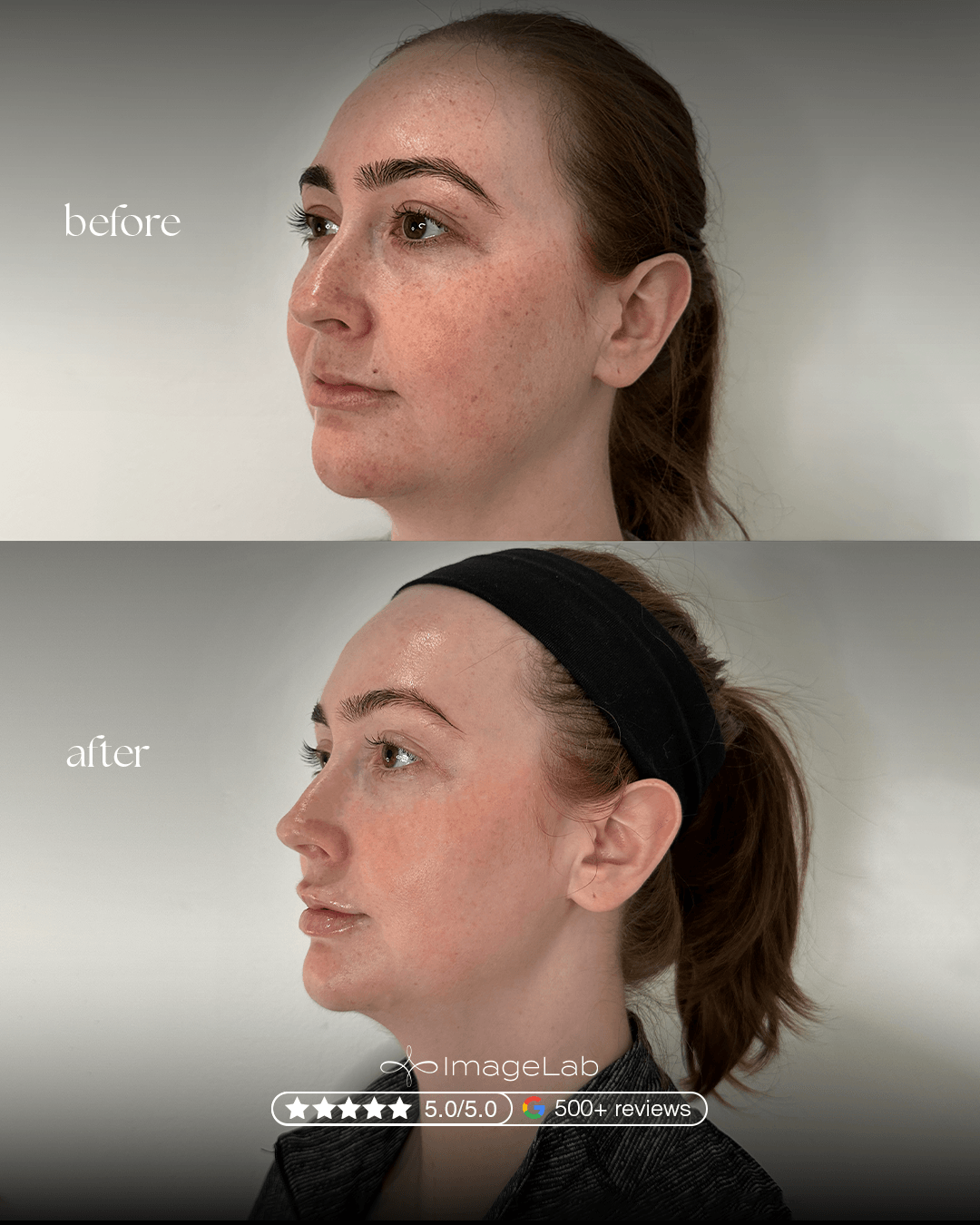 Before and after result