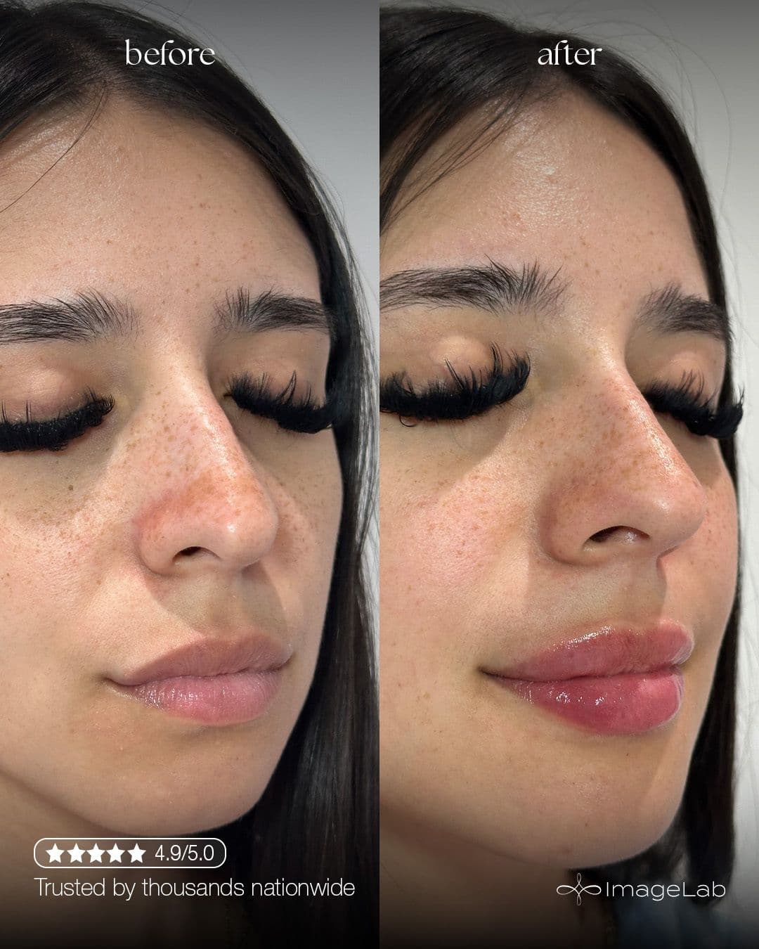 Lip Filler result at ImageLab Med Spa