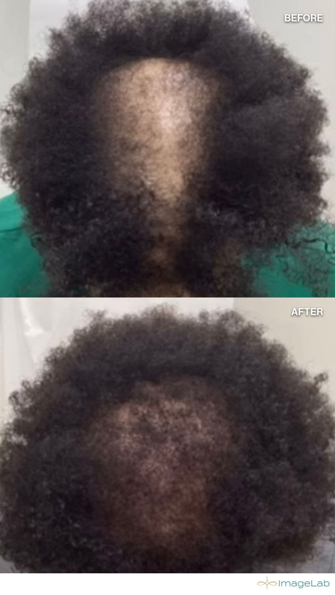 PRP Hair Restoration result at ImageLab Med Spa
