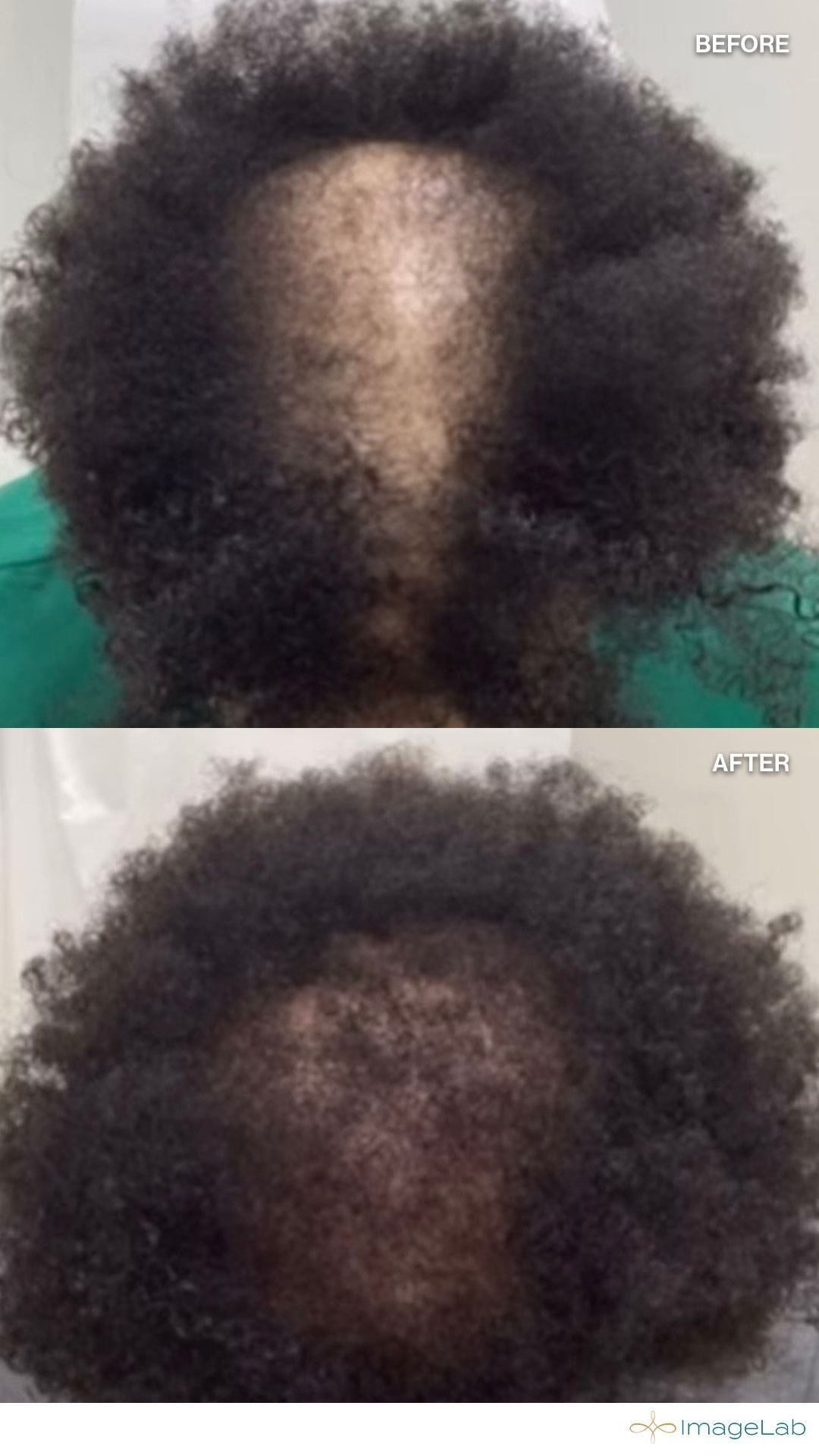 Before and after result