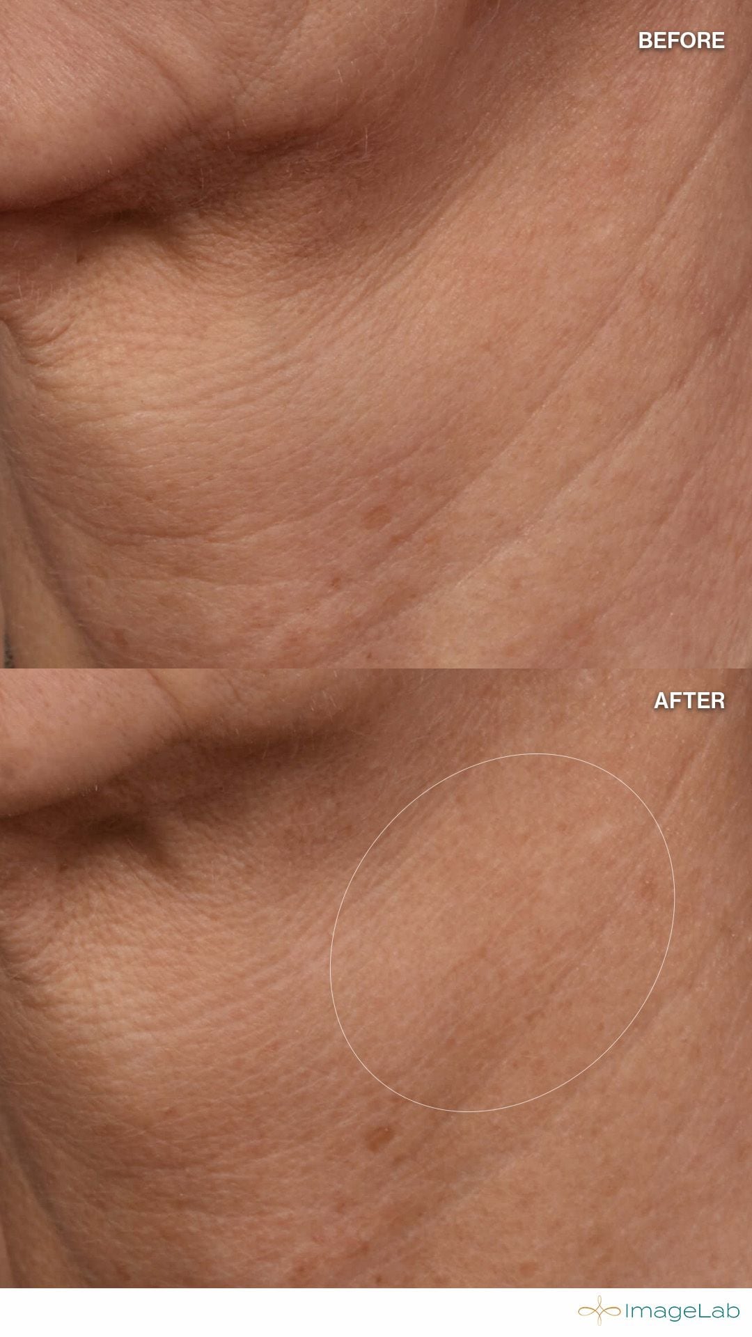 Before and after result