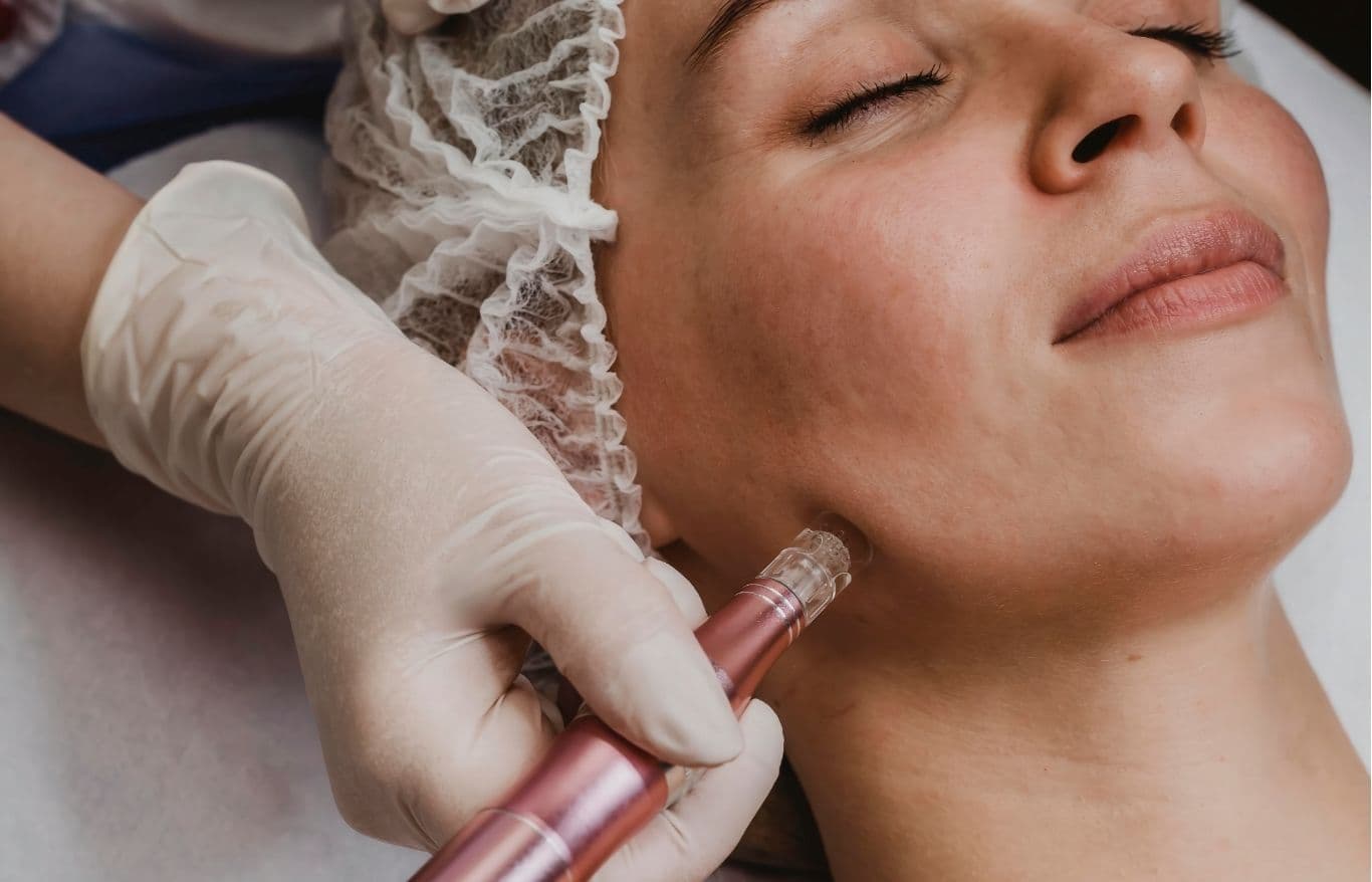 facial microneedling alexandria