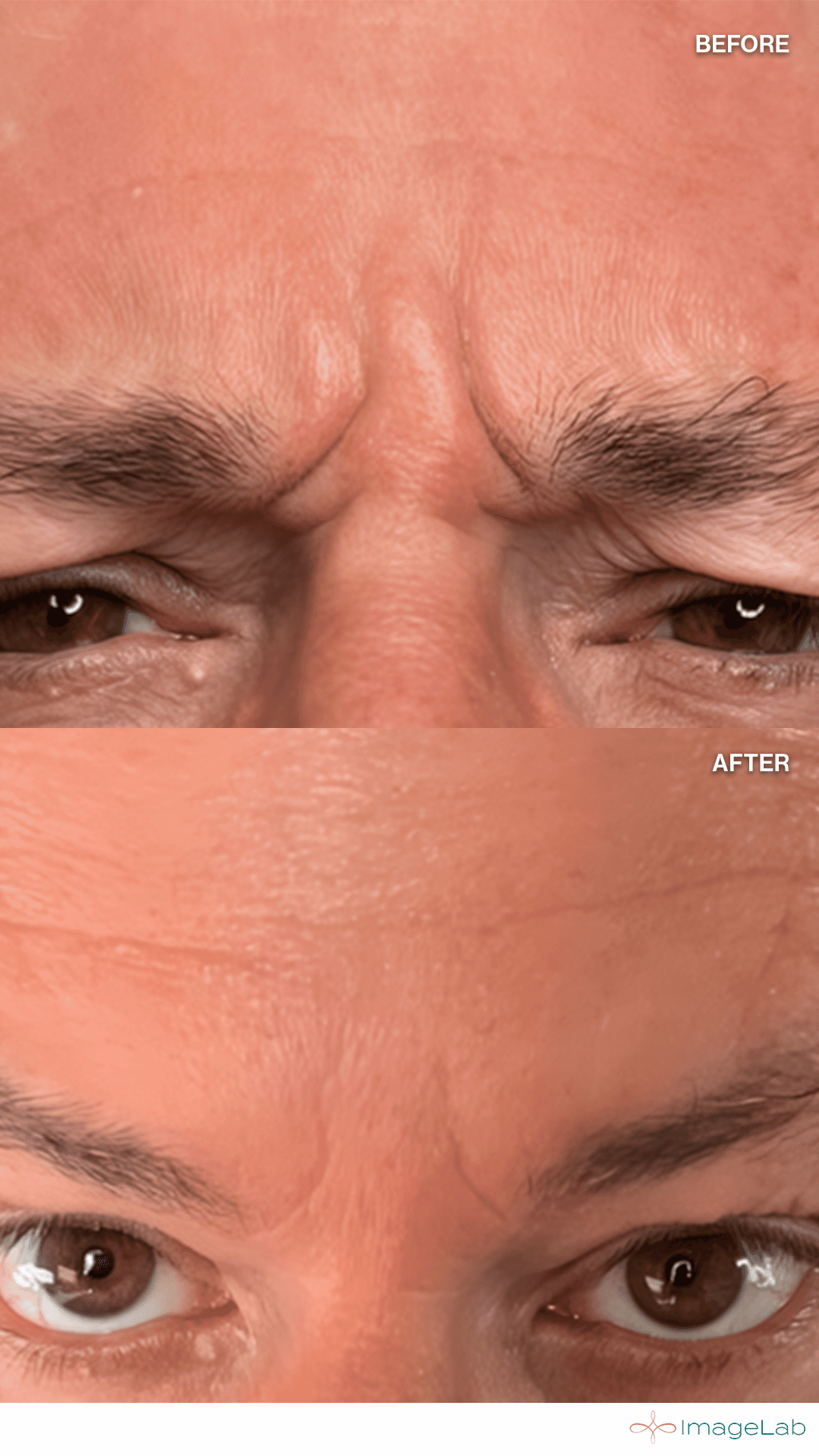 Botox for Men result at ImageLab Med Spa