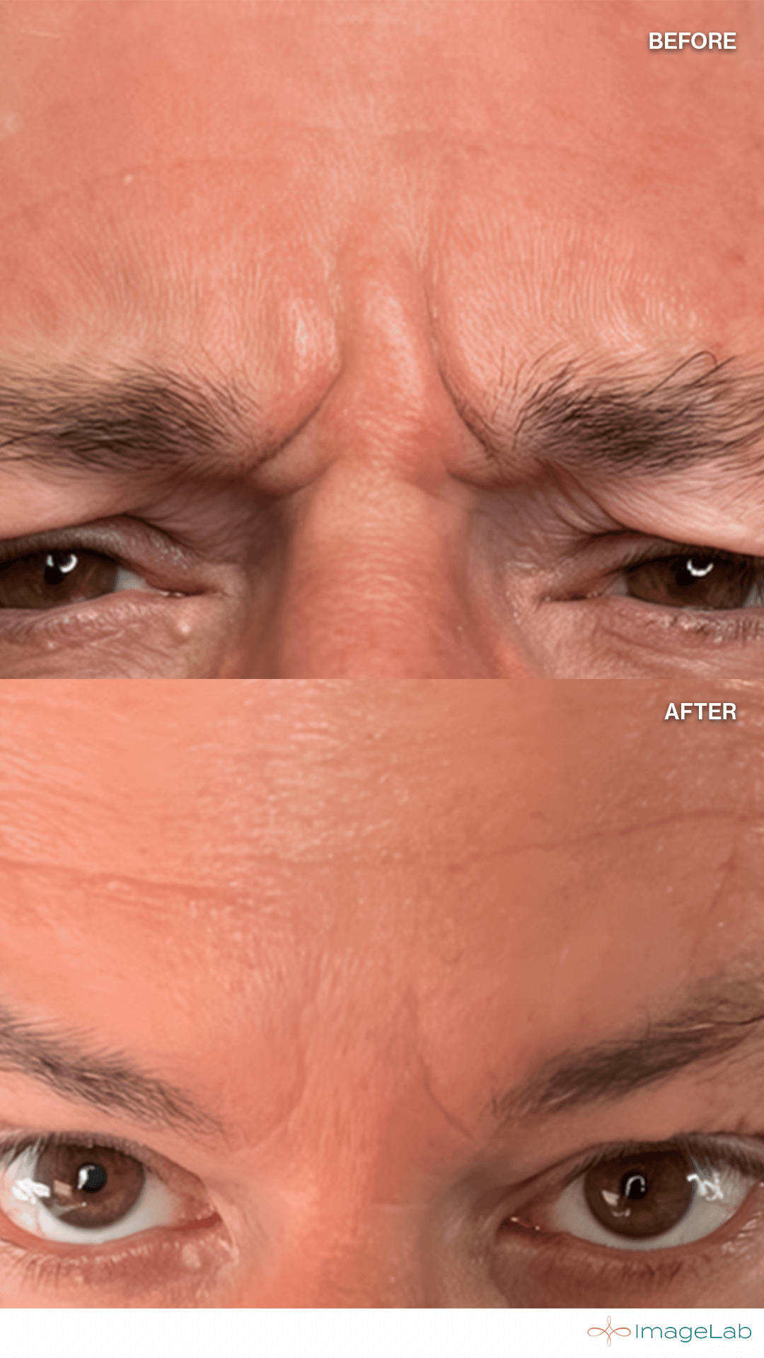 Before and after result