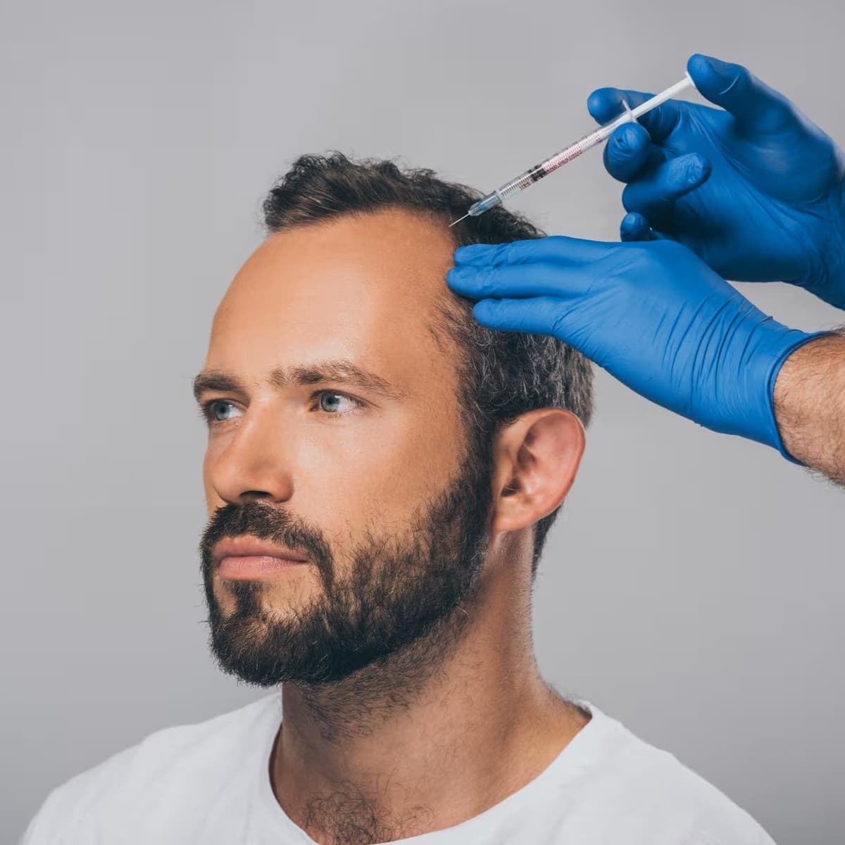 Exosome Hair Restoration