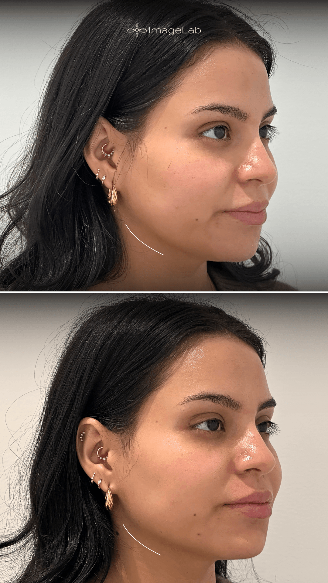 Before and after result