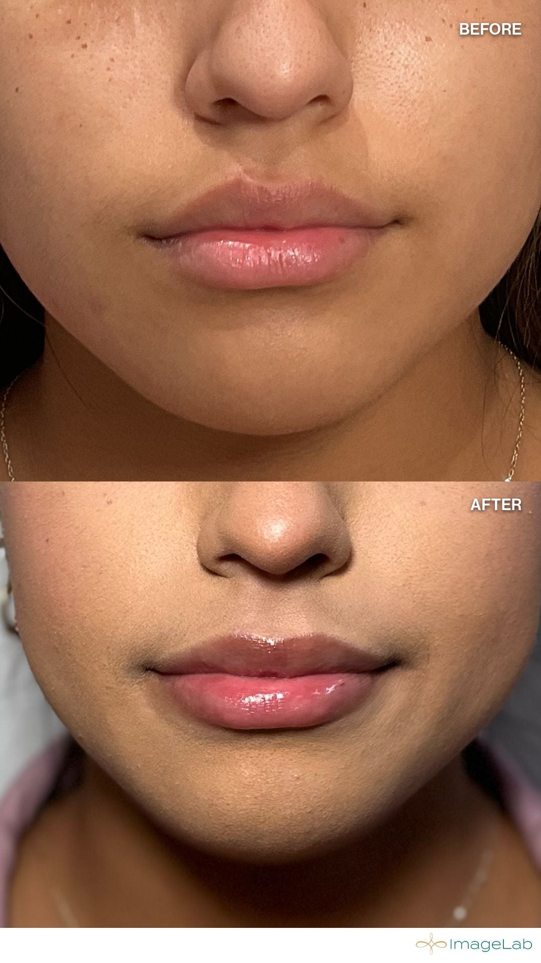 Before and after result