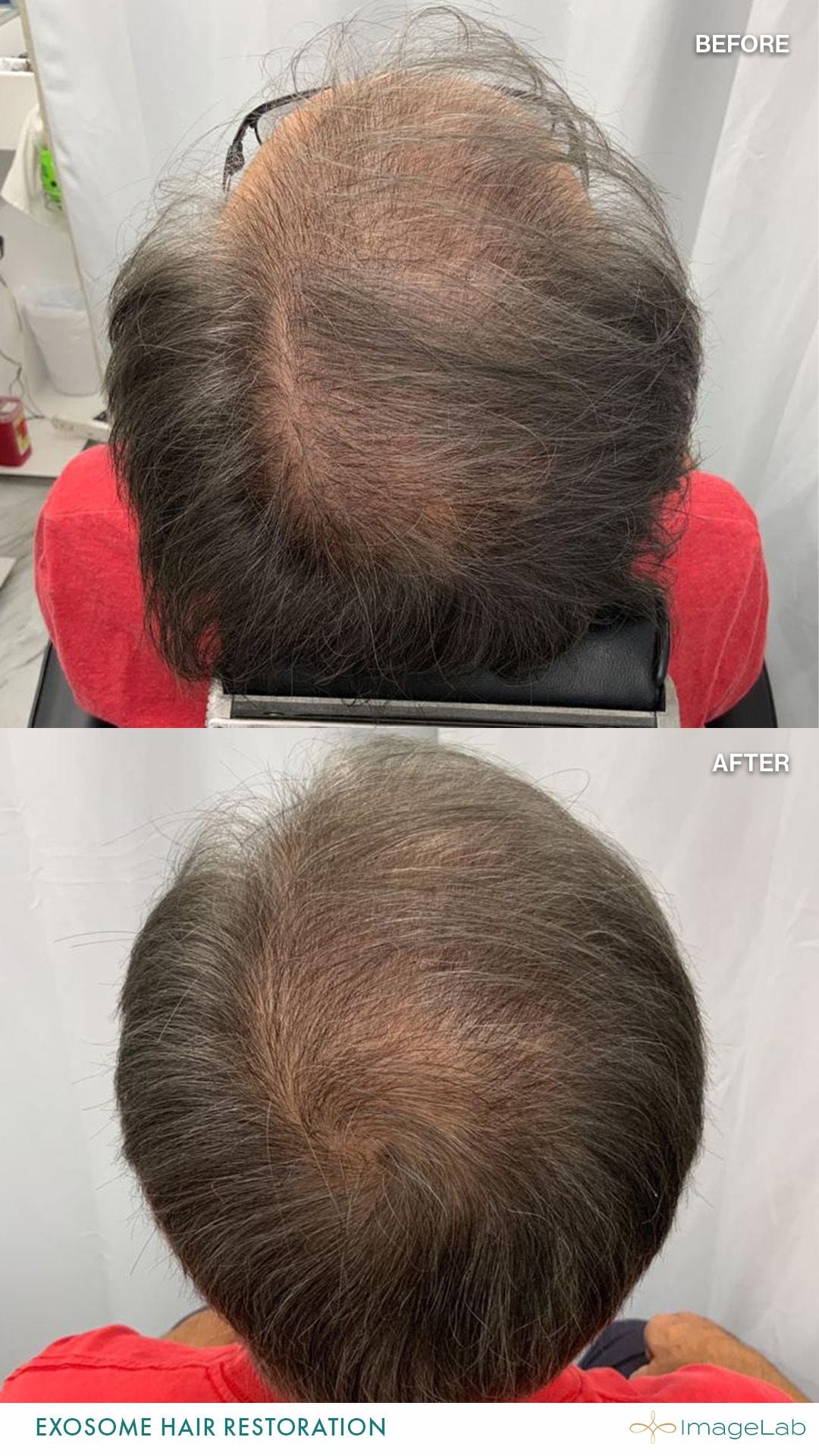 Before and after result