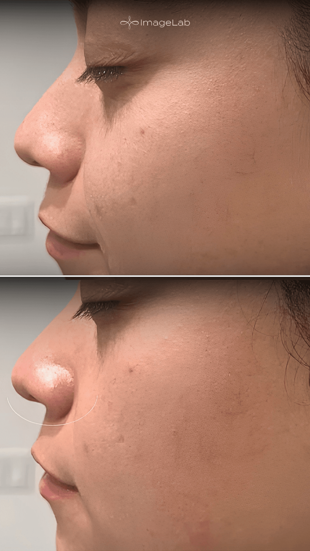 Before and after result