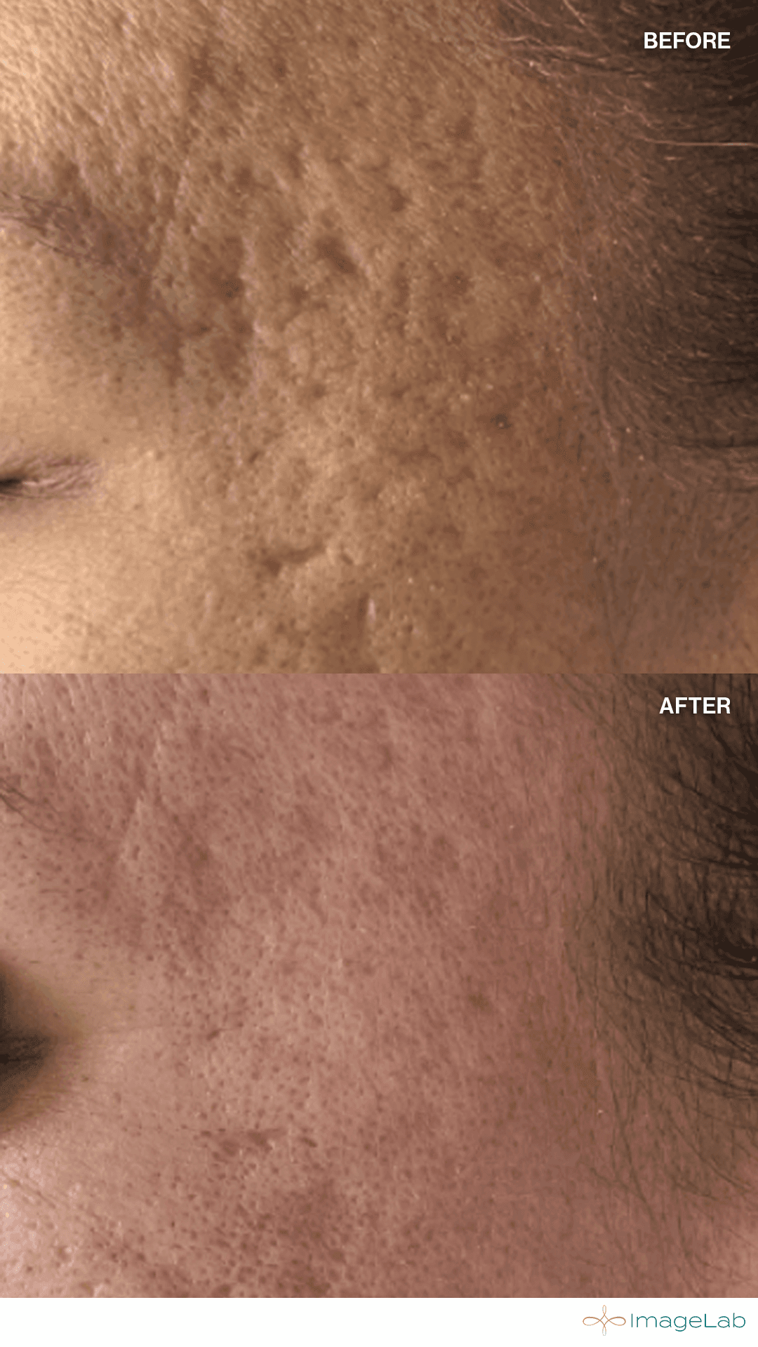 Microneedling result at ImageLab Med Spa