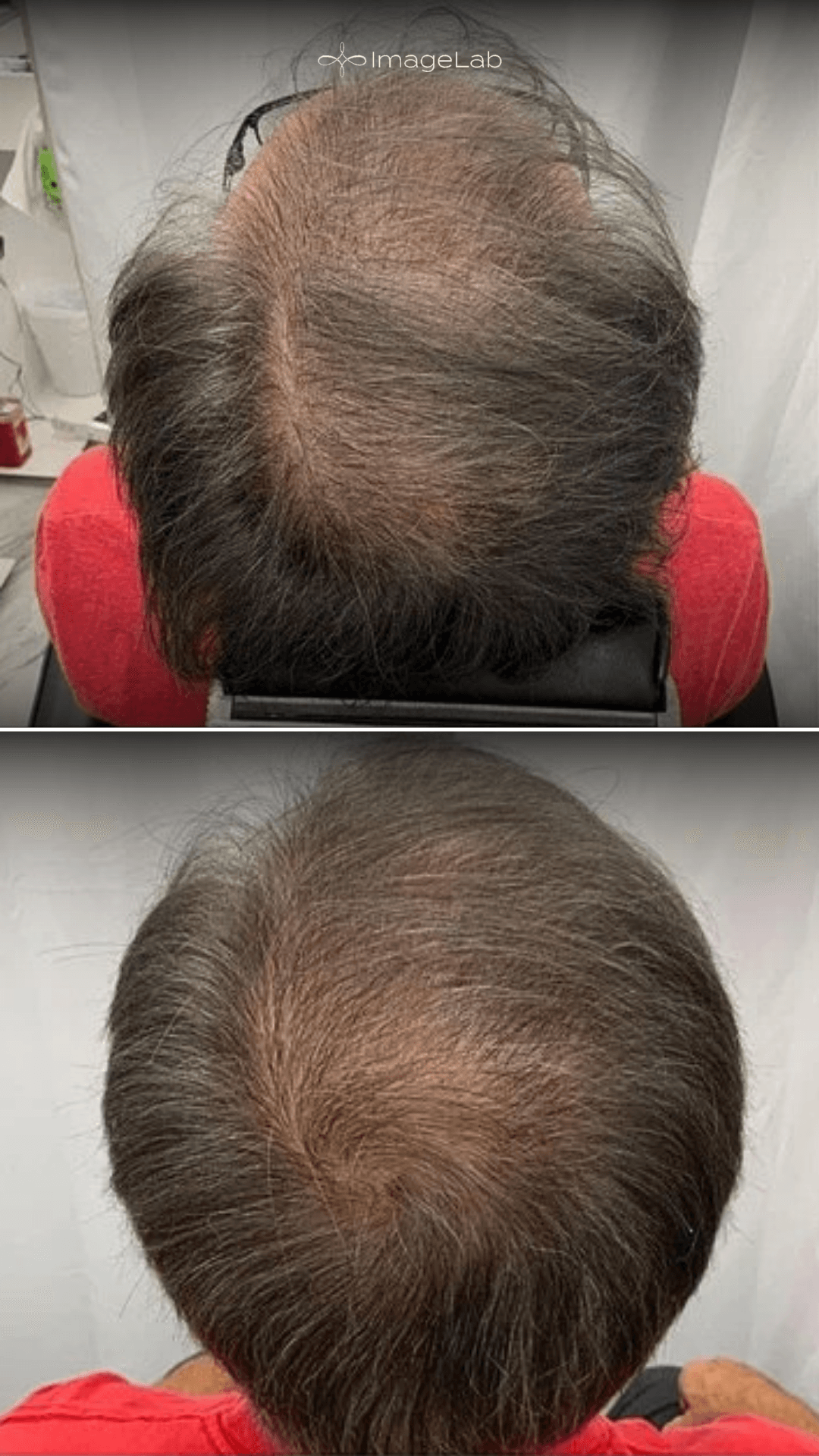 Before and after result