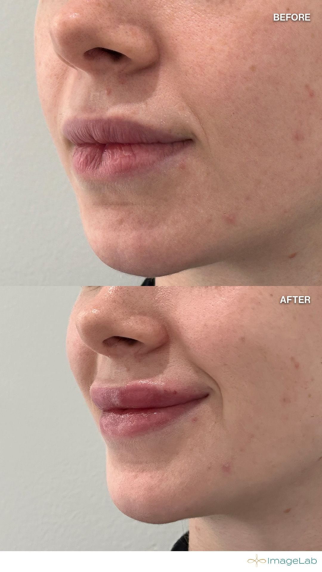 Before and after result