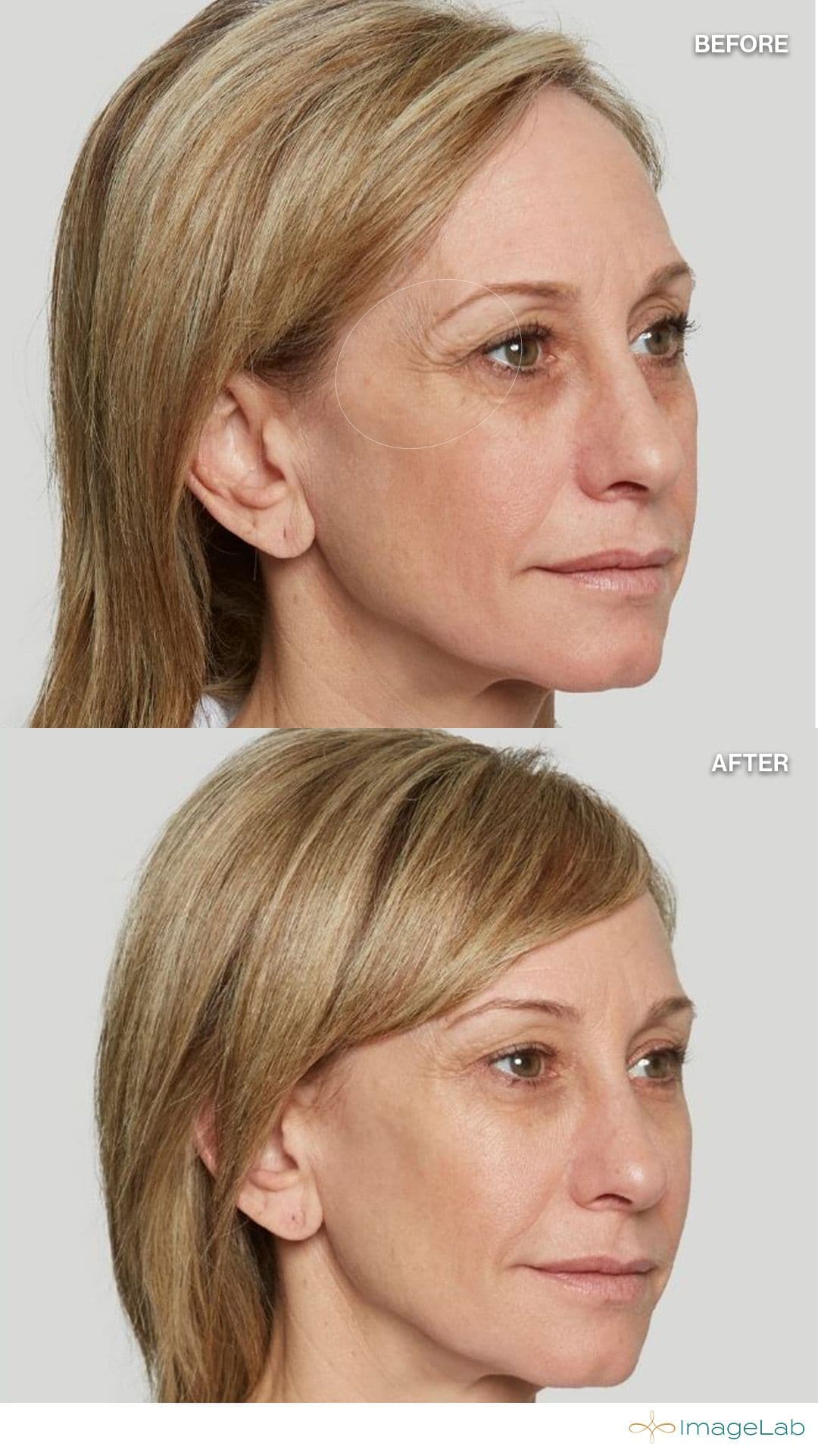 Before and after result