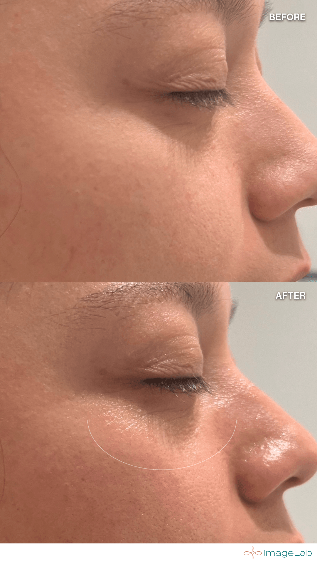 Before and after result