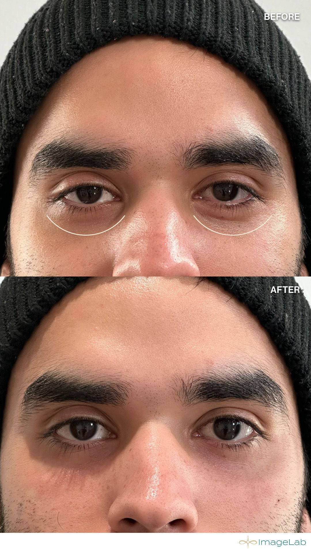 Before and after result