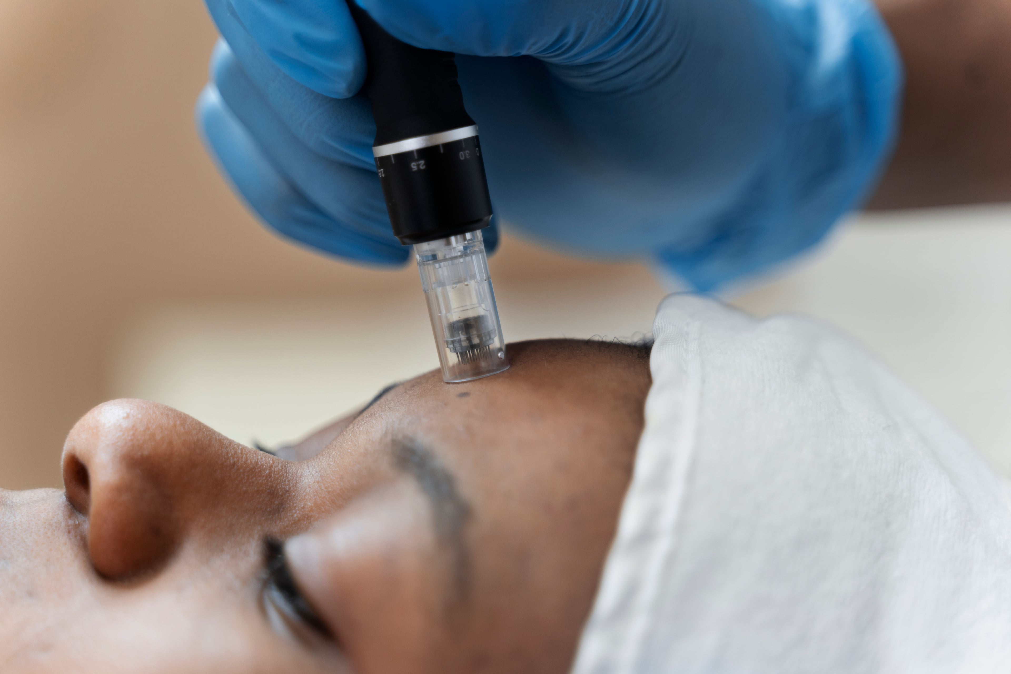 SkinPen microneedling treatment at ImageLab Med Spa in Chicago