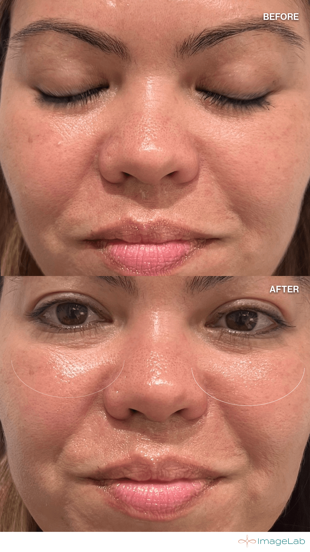 Before and after result