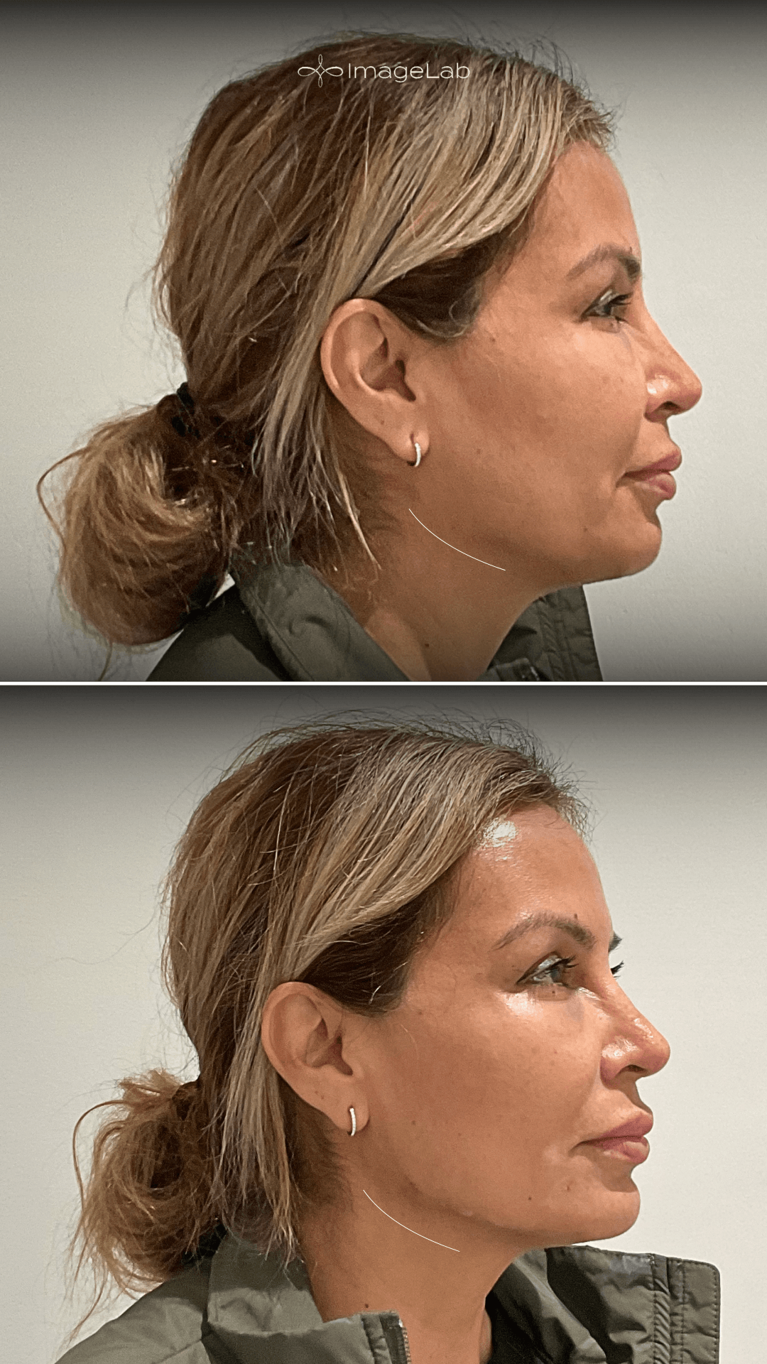 Before and after result