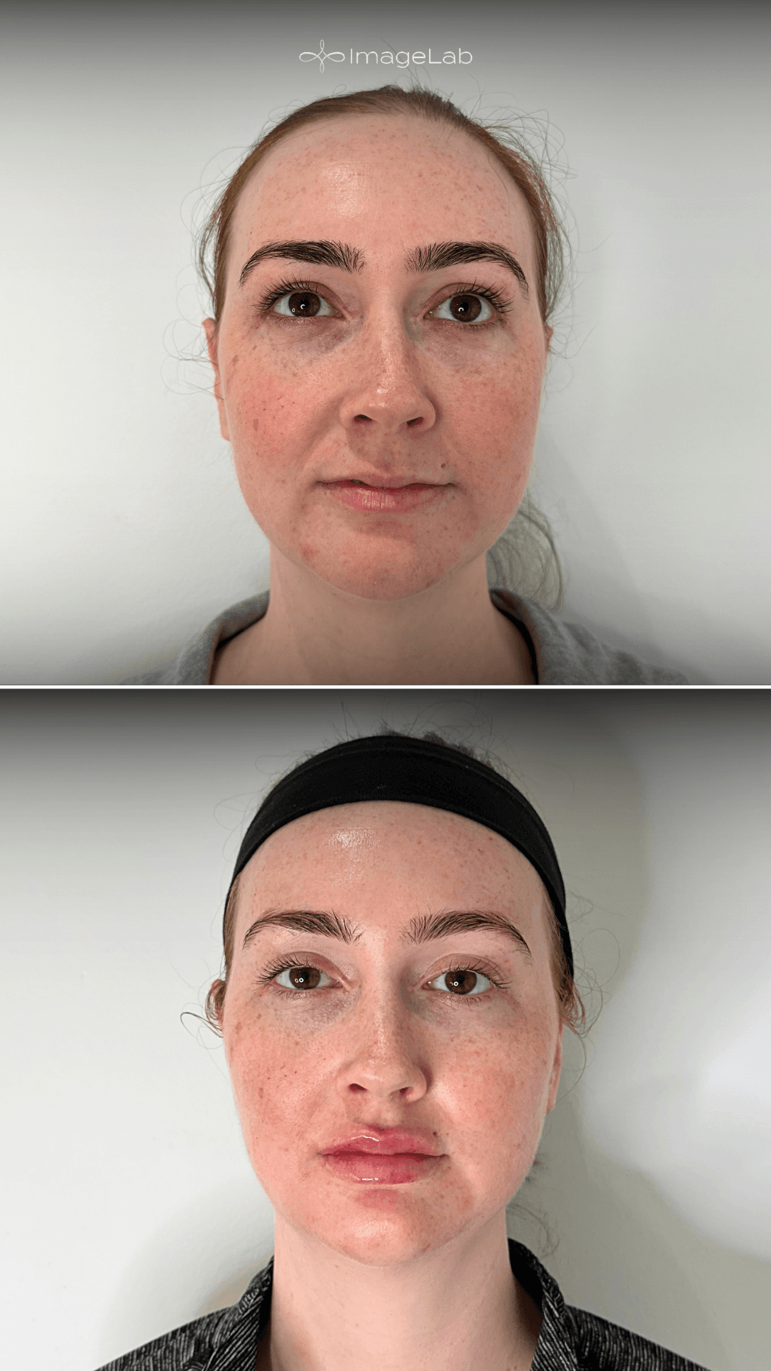 Facial Balancing result at ImageLab Med Spa