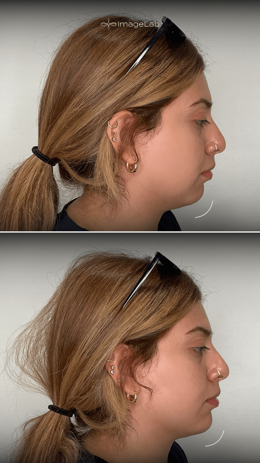 Before and after result